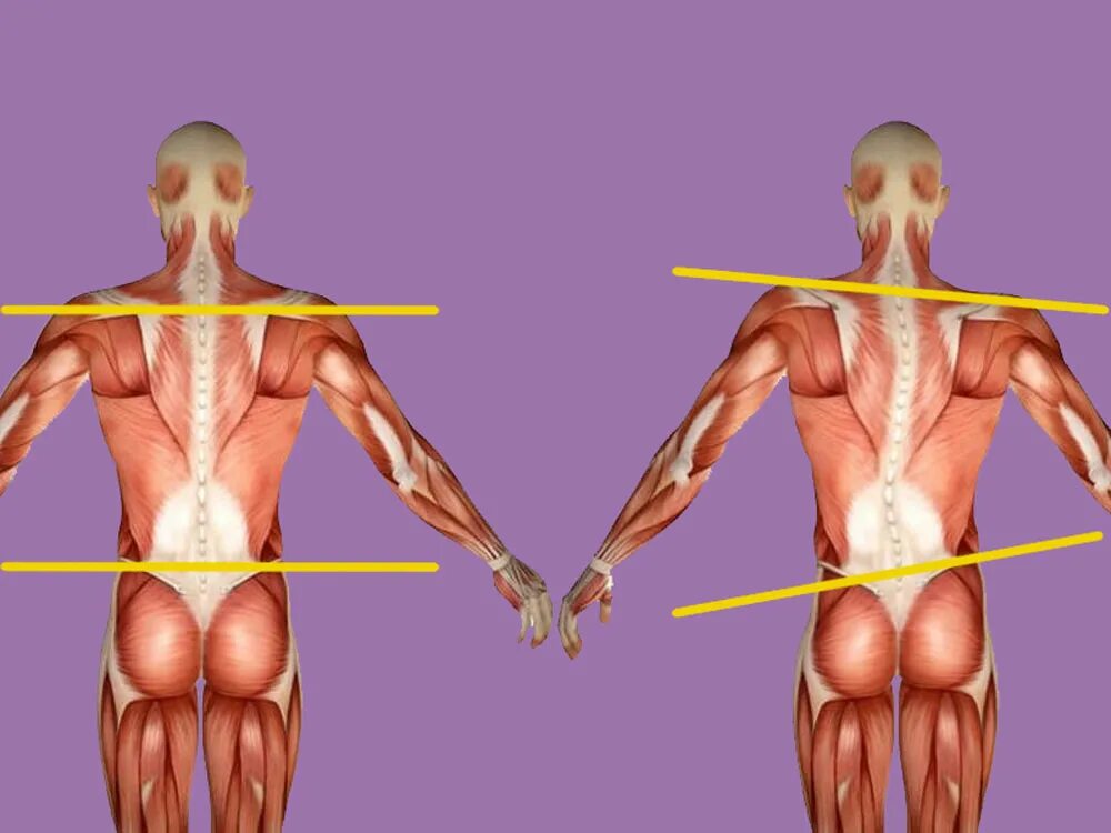 Сколиоз гипертонус мышц. Асимметрия тела. Диспропорция мышц спины. Асимметрия мышц тела. Зажим в пояснице