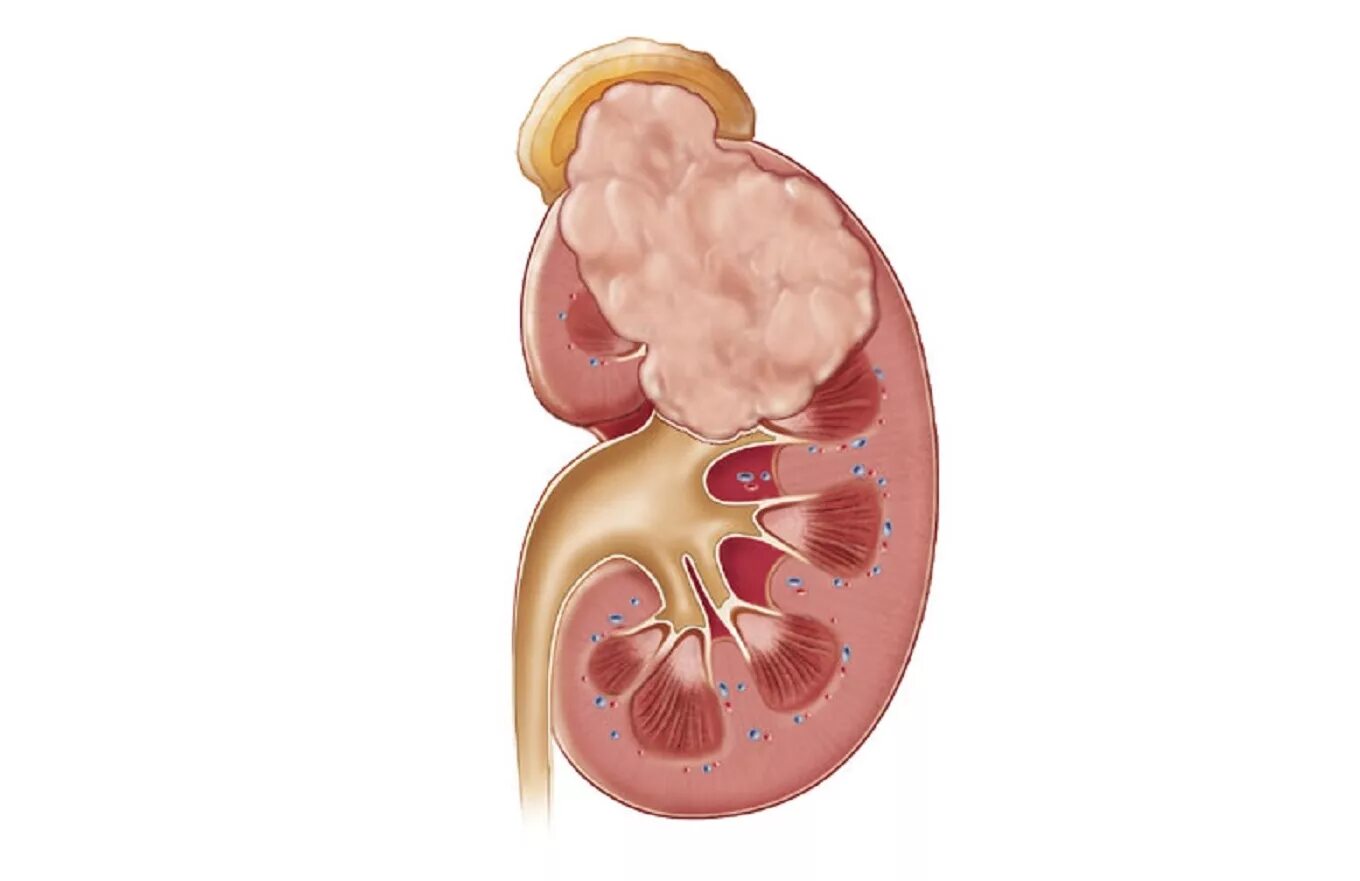 Рак почки причины. Карбункул почки макропрепарат. Карбункул почки пиелонефрит. Околопочечный абсцесс. Карбункул и абсцесс почки.