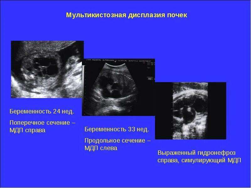 Мультикистозная почек плода. Кистозная дисплазия почек узи. мультикистоз почки у плода. мультикистоз почек у детей узи. мультикистозная дисплазия.