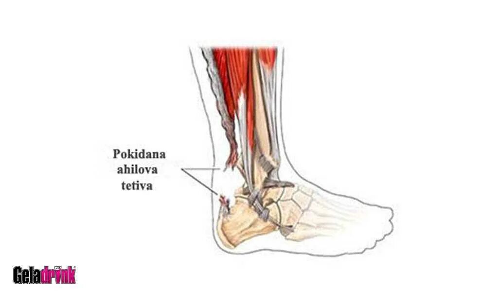 Ахиллесово сухожилие разрыв. Ахиллово сухожилие растяжение. Тендинит ахиллова сухожилия. Разрыв ахиллова сухожилия голеностопного сустава.