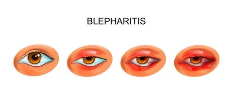 Blepharitis латынь