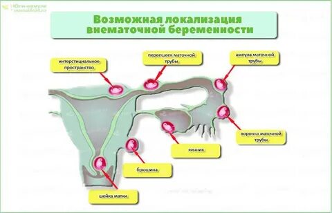Осложнения трубной беременности