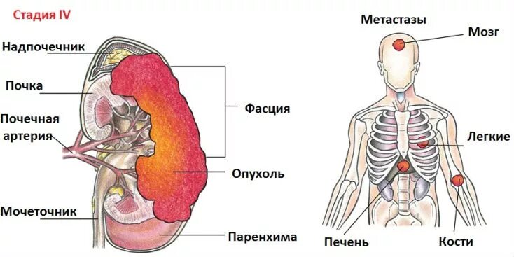 С метастазами 4 степени сколько живут. Метастазирование опухоли почки. Метастазы опухоли почки. Отдаленные метастазы почки. Метастазы опухоли почки в легкие.