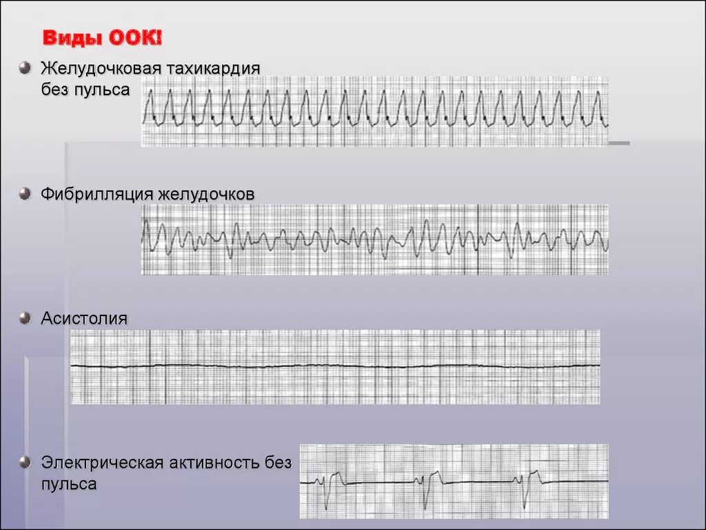 Электрическая активность без пульса на ЭКГ. Желудочковая тахикардия без пульса. Желудочковая тахикардия без пульса на ЭКГ. Фибрилляция желудочков желудочковая тахикардия без пульса.