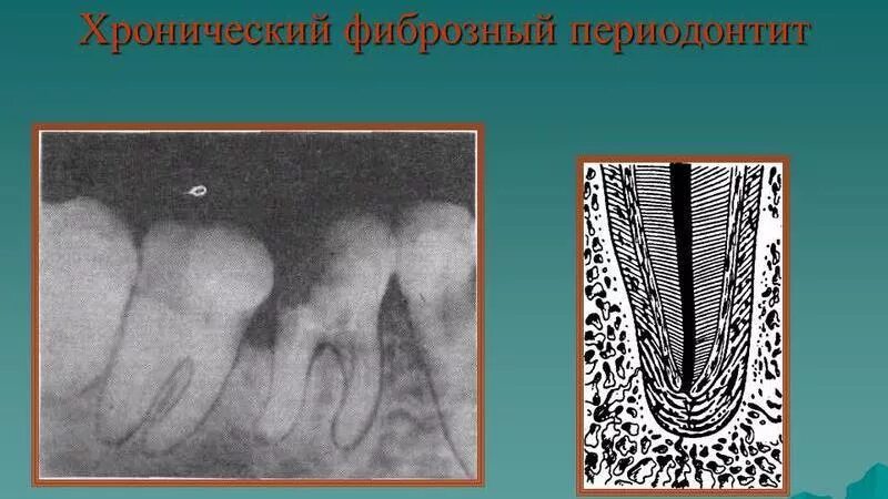 Фиброзный периодонтит. Гранулематозный периодонтит на рентгенограмме. Периодонтит фиброзный гранулематозный гранулирующий. Хронический фиброзный периодонтит рентген. Хронический фиброзный пе.