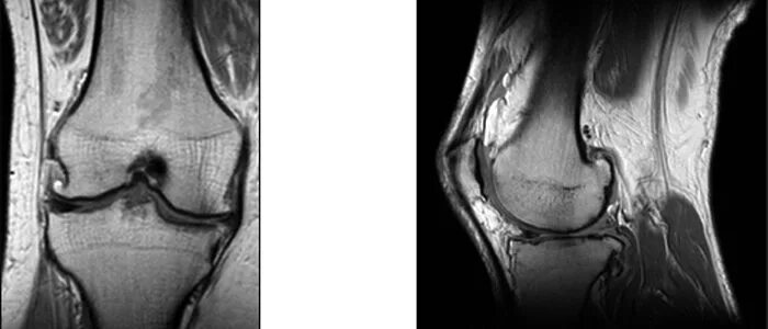 остеохондропатия коленного сустава кенига. инфаркт костного мозга большеберцовой кости мрт. некроз коленного сустава лечение. синовиома коленного сустава рентген. некроз коленного сустава лечение.