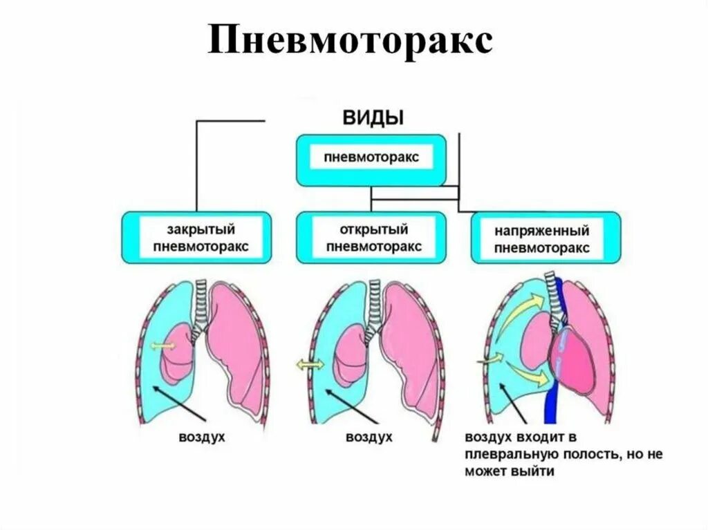 Пневмоторакс истории. Спонтанный пневмоторакс рентген. Спонтанный пневмоторакс. Левосторонний спонтанный пневмоторакс. Тип дыхания при пневмотораксе.