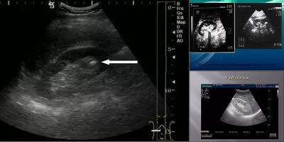 как выглядит песок в почках на узи