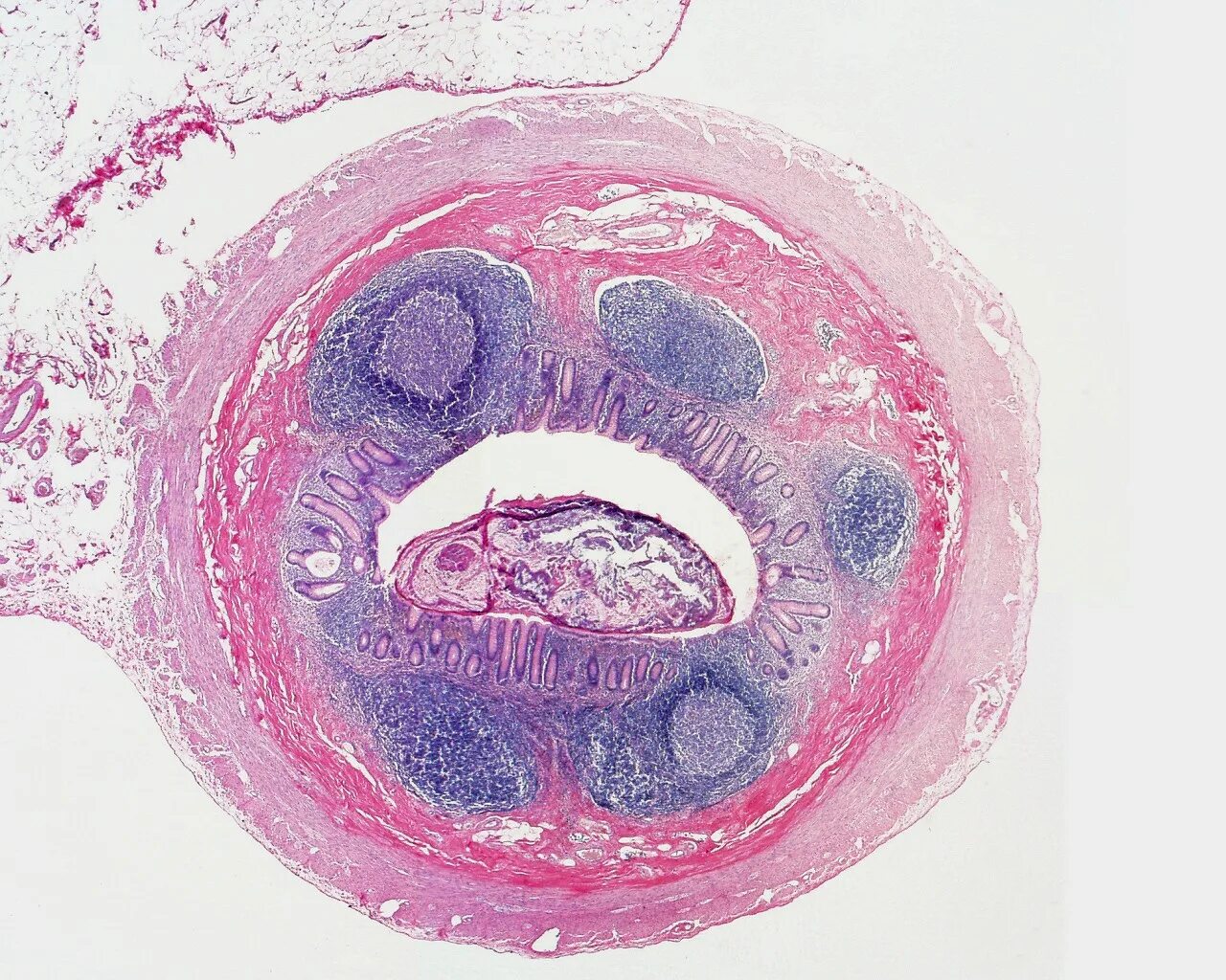 Червеобразный отросток гистология. Аппендикс гистология препарат. Лимфоидная ткань аппендикса. Мукоцеле аппендикса гистология.
