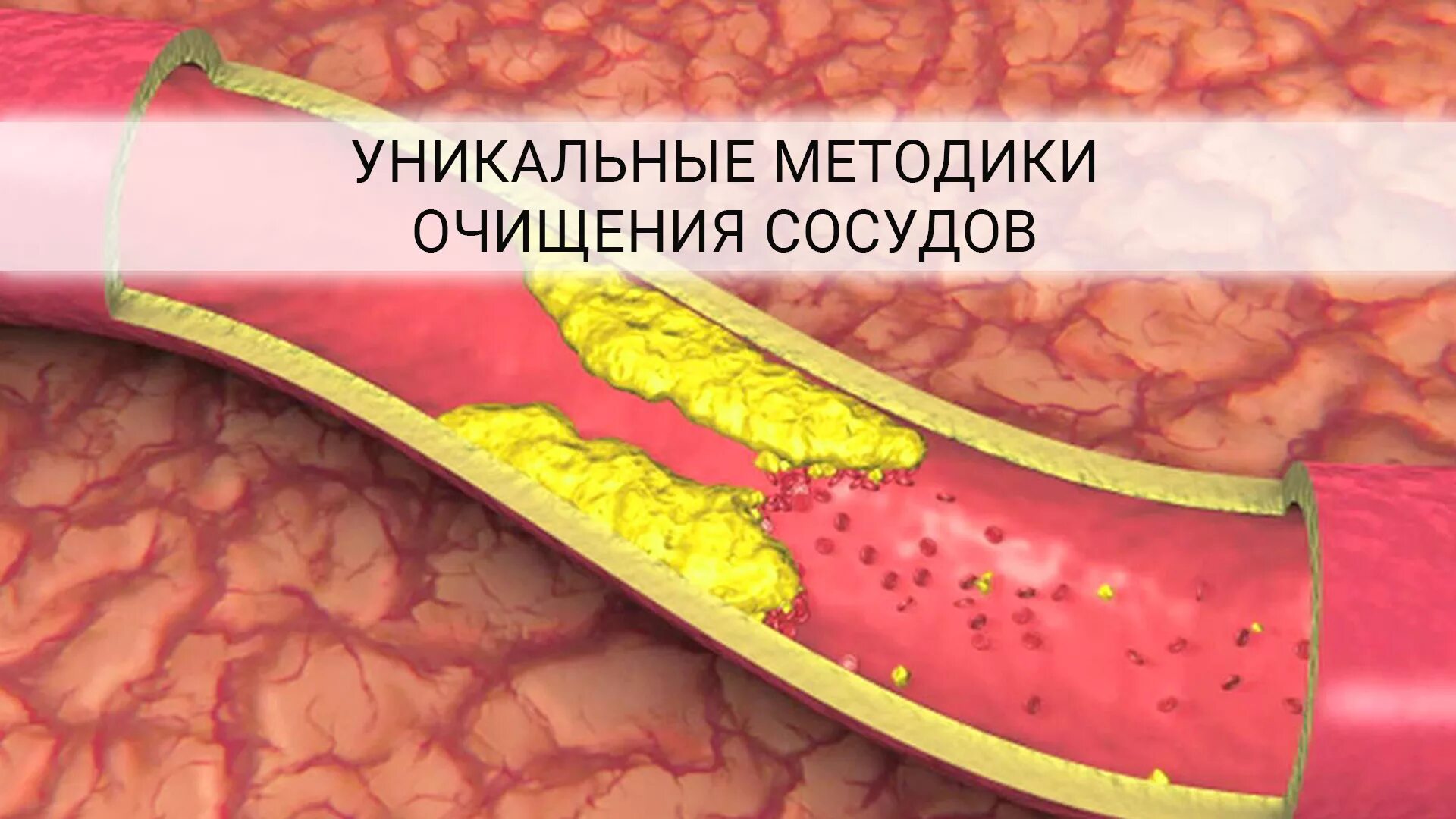 Как почистить тромбы. Очищение сосудов. Очищение кровеносных сосудов. Очистить кровеносные сосуды.