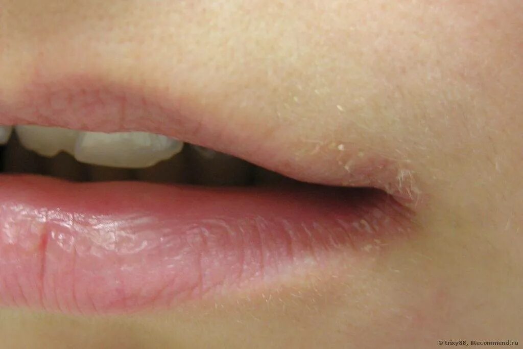 Трещина на губе чем мазать. Ангулярный хейлит (хейлоз, ангулярный стоматит).