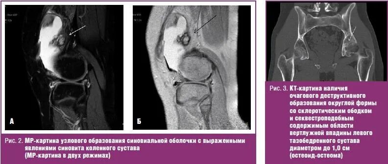 Артрит кт. Синовит тазобедренного сустава мрт. Ювенильный артрит тазобедренного сустава кт. Хондроматоз тазобедренного сустава мрт.
