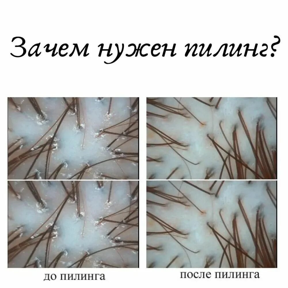 Кожа головы до и после пилинга. Пилинг кожи головы фото до и после. Пилинг для волос и кожи головы до после. Пилинг головы до после. Пилинг кожи головы фото до и после.