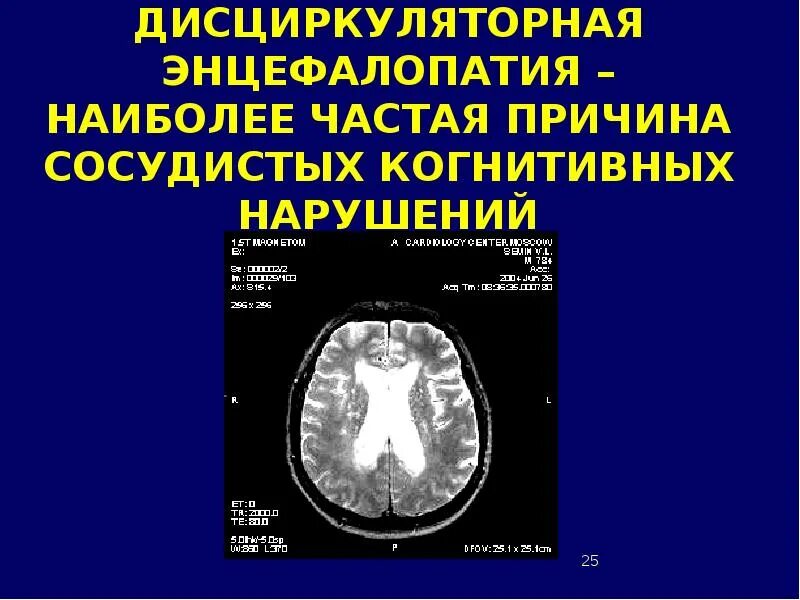 Дисциркуляторная энцефалопатия. Дисциркуляторная энцефалопатия на кт. Профилактика дисциркуляторной энцефалопатии. Клиника дисциркуляторной энцефалопатии. Дисциркуляторные дистрофические изменения