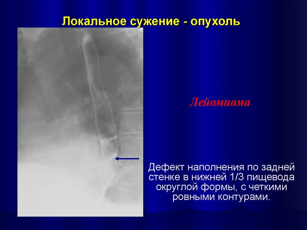 Сужение пищевода причины