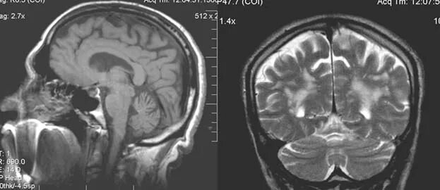 Атрофия головного мозга мрт. Атрофия головного мозга на кт. Атрофия лобных долей мрт. Атрофия головного мозга 1