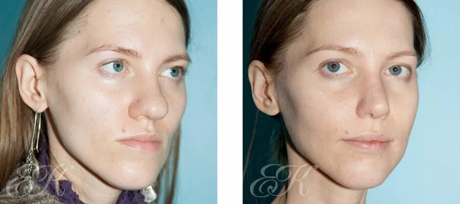 моделирование ринопластики