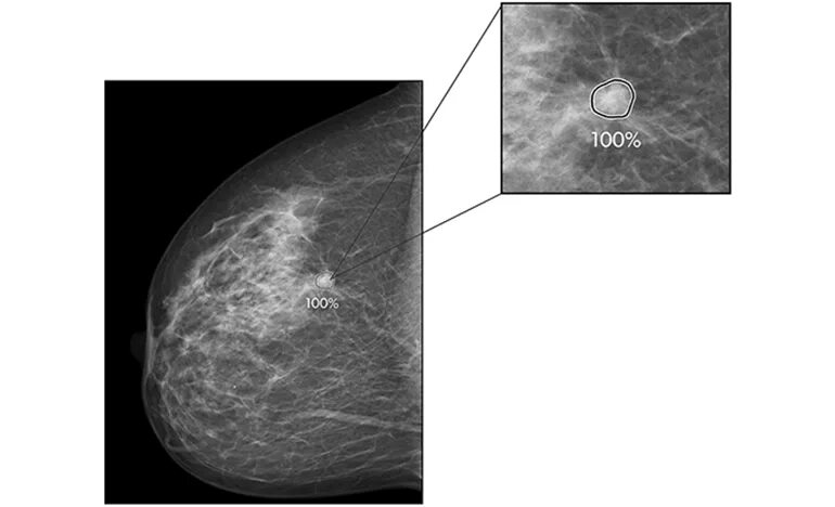 Маммография старый. Рентген молочных желез маммография. Цифровая маммография молочных желез. Маммография искусственный интеллект. Маммография для маленьких молочных желез.