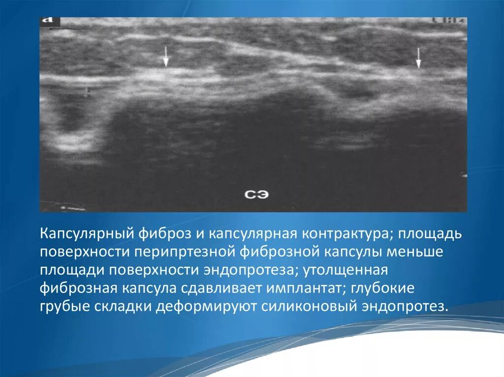 Что означает фиброзное изменение. Капсулярная контрактура. Фиброзно капсульная контрактура. Имплант молочной железы на УЗИ. Фиброз на УЗИ молочных желез.