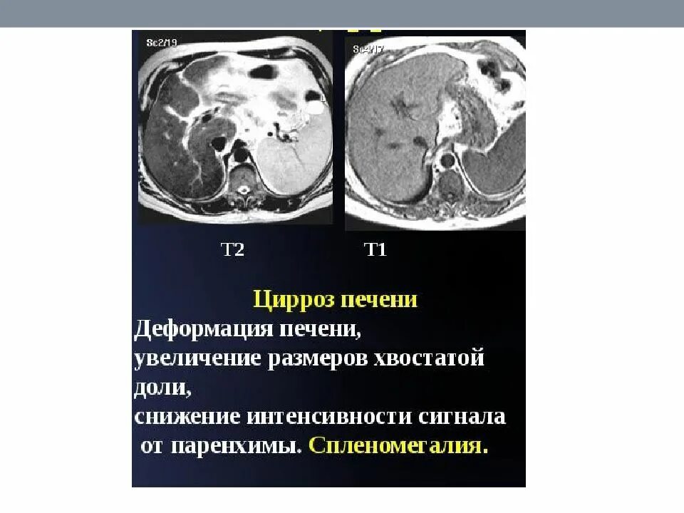 Образование в правой доле печени. Гипертрофия хвостатой доли печени. Увеличение хвостатой доли печени. Доли печени на кт.