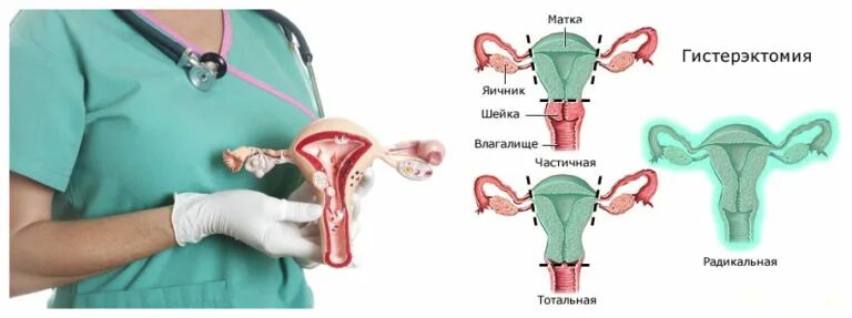 Миома матки экстирпация. Тотальная экстирпация матки. Экстирпация матки осложнения. Экстирпация матки (тотальная гистерэктомия). Тотальная матка