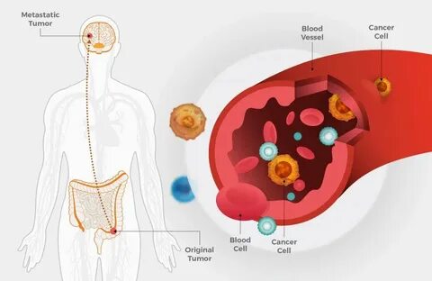 Metastasis