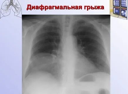 Грыжа средостения