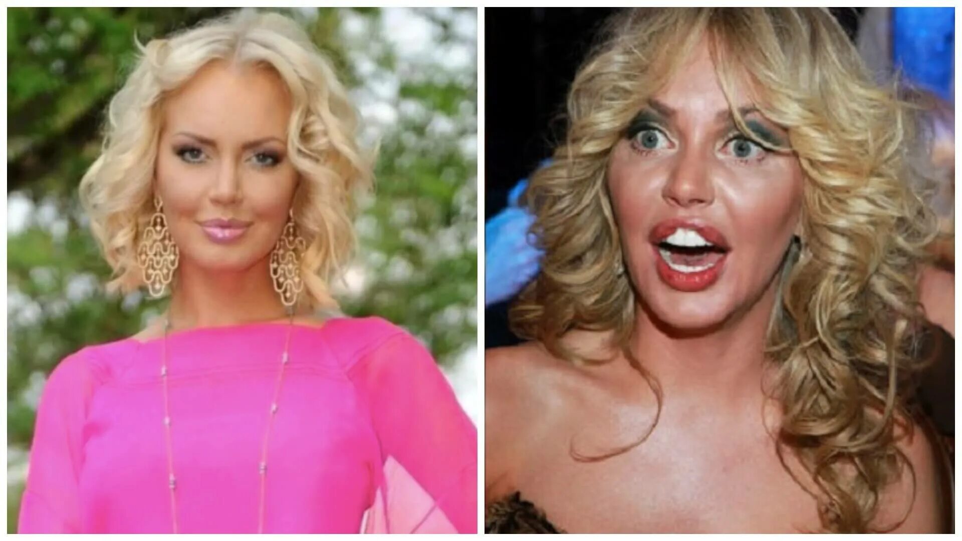 Малиновская до и после пластики. Маша малиновская до пластики и после пластики. Малиновская до и после пластики. Малиновская маша до и после пластики. Малиновская маша до операций.