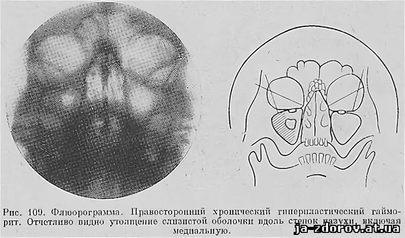 Локальное утолщение слизистой. Гиперпластический синусит кт. Хронический гиперпластич гайморит кт. Утолщение слизистой оболочки пазух рентген. Гиперпластический гайморит рентген.