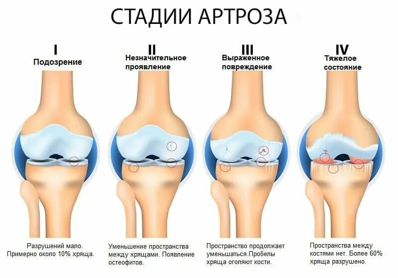 Гонартроз к какому врачу