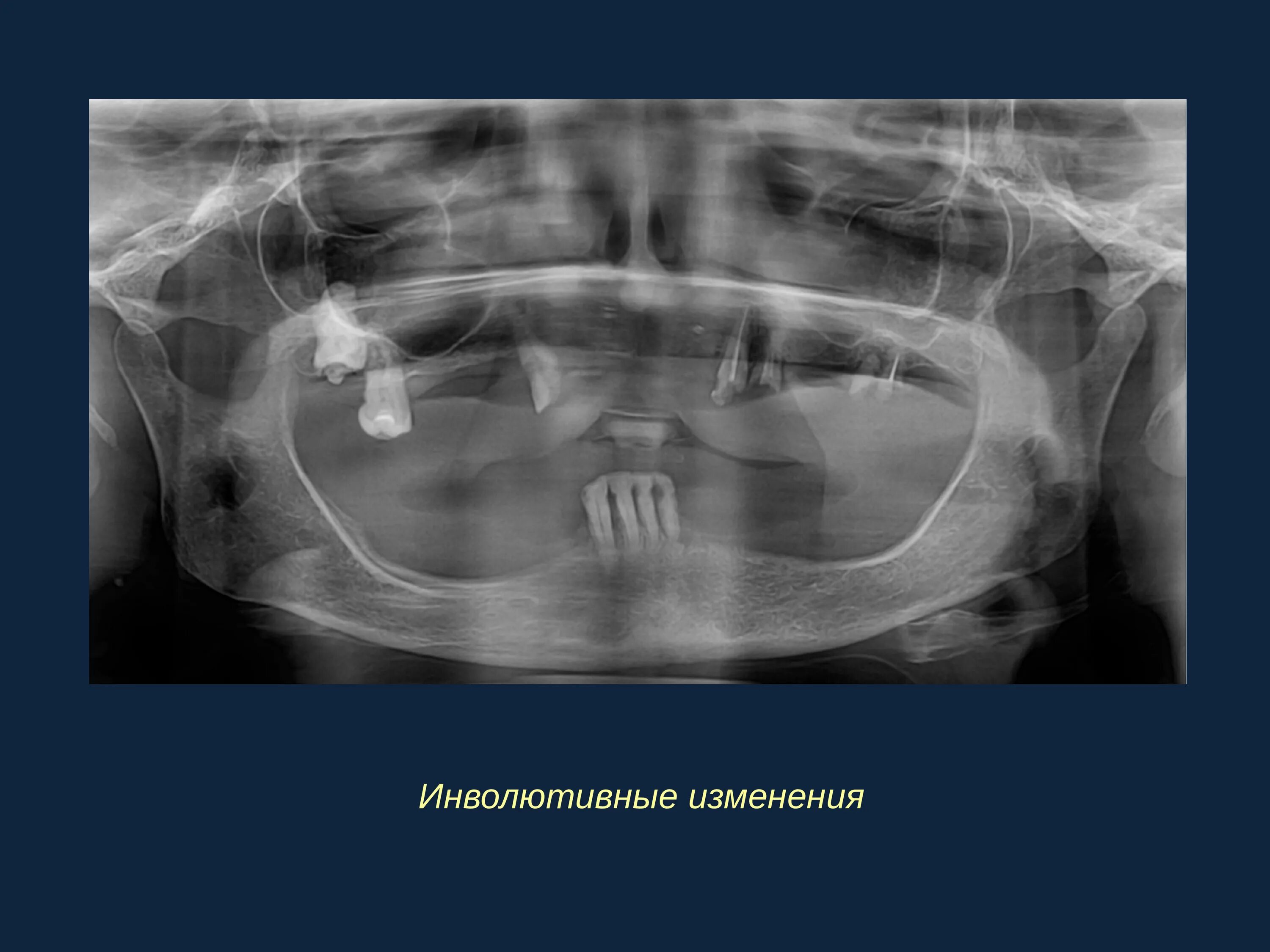 Инволютивные изменения яичников что это. Инволютивные изменения. Инволютивные изменения зубов. Инволютивные изменения челюстей. Инволютивная хрупкость это.