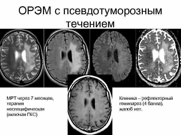 Демиелинизация головного. Острый рассеянный энцефаломиелит мрт. ОРЭМ кт головного мозга. ОРЭМ мрт. Демиелинизация головного мозга мрт.