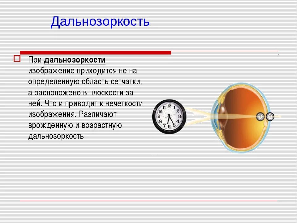 Дальнозоркость это когда. Дальнозоркость. При дальнозоркости. Дальнозоркость в физике. Дальнозоркость возникает при.