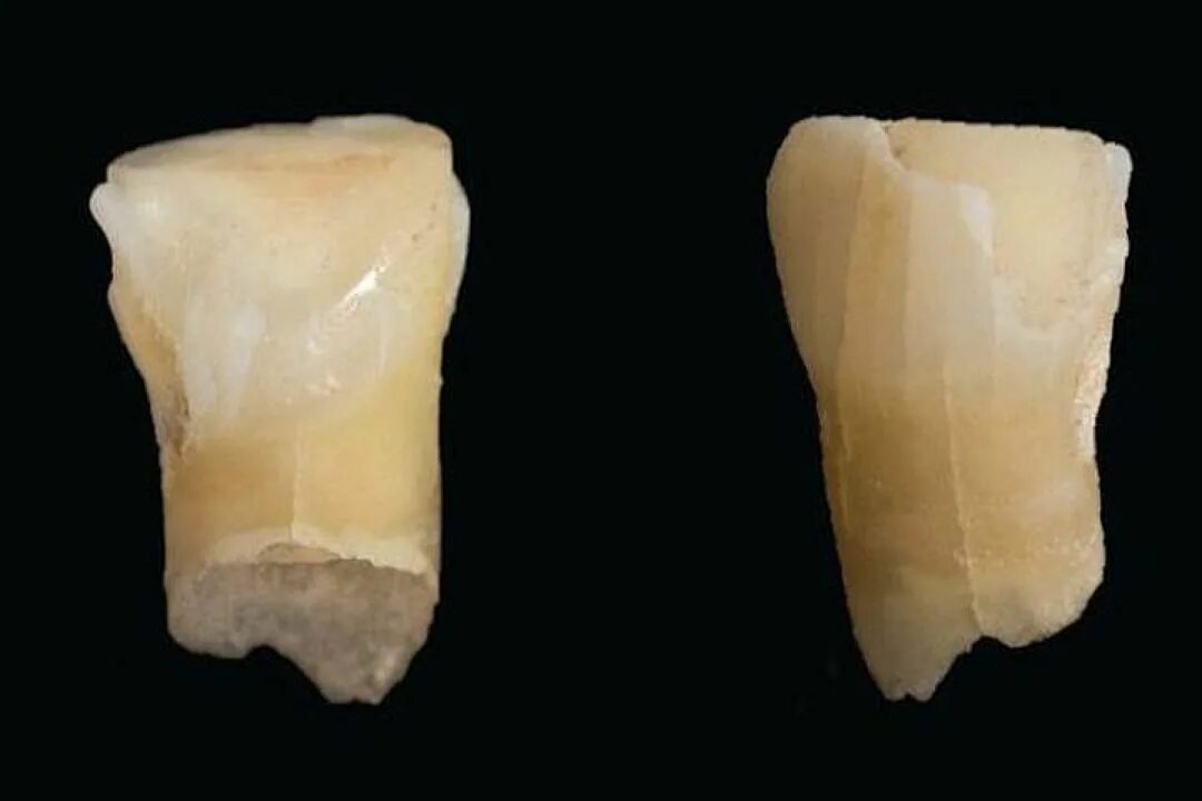 молочный медиальный резец верхней челюсти. выпал верхний резец молочный. молочный передний нижний резец. центральный молочный резец. молочный зуб нижний резец.