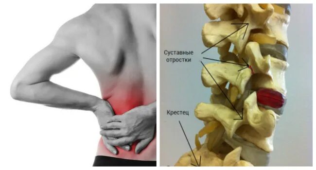 Спондилоартроз l4 l5 сегмента. Спондилоартроз l4 l5 сегмента. Спондилоартроз шейного отдела позвоночника кт. Антелистез л5. Остеохондроз спондилоартроз поясничного отдела.