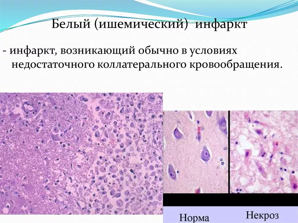 Микропрепарат головного мозга. Ишемический инсульт макропрепарат. Белый инфаркт почки макропрепарат. Ишемический инсульт патанатомия препарат. Инсульт головного мозга гистология.