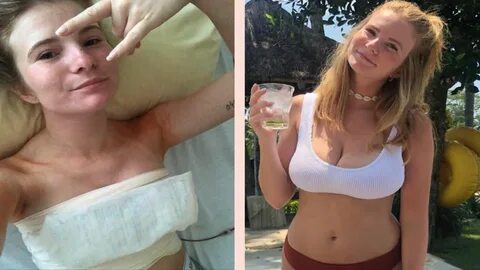 Erfahrungsbericht: Ich ließ mir mit 21 Jahren die Brüste verkleinern 