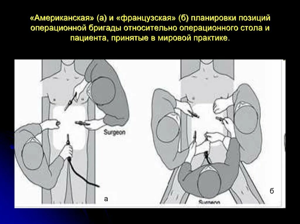 Пдр операция. Лапароскопическая холецистэктомия доступ. Положение пациента при лапароскопической холецистэктомии. Холецистэктомия лапароскопическим методом это. Лапароскопическая холецистэктомия эндофото.