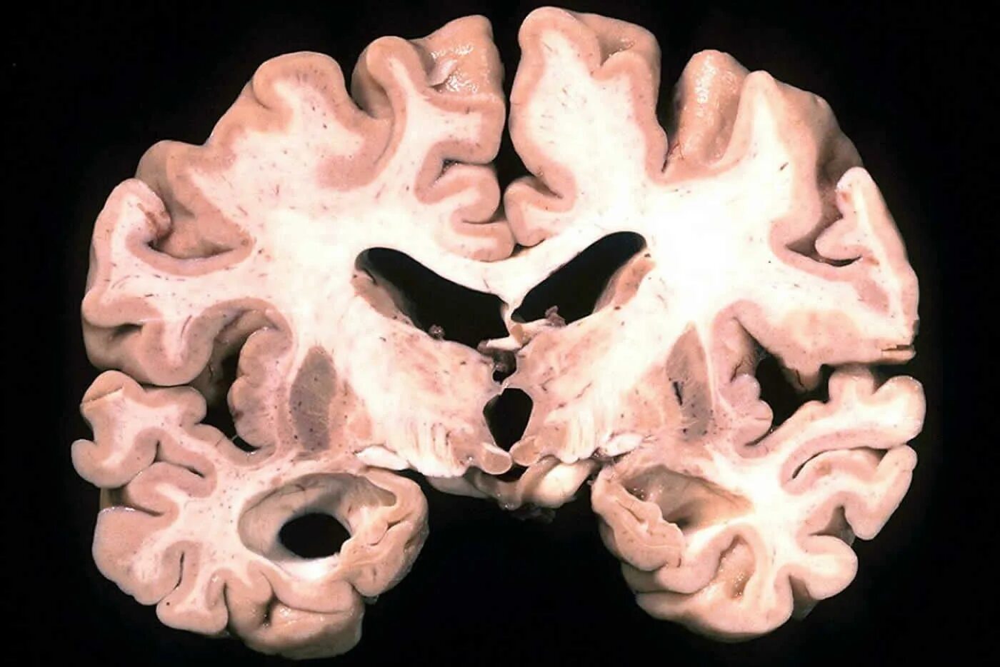 Деменция головы. Болезнь Alzheimer. Головной мозг при болезни Альцгеймера.