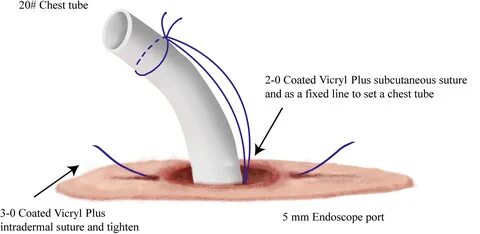 Drainage tube hole suture improvement: Removal‐free stitches - Fu.