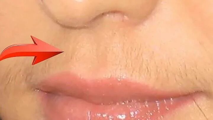 Эпиляция усиков над верхней губой. Избавиться от усиков над губой. Осветление волос над верхней губой. Усики над верхней губой. Избавиться от усиков над губой.