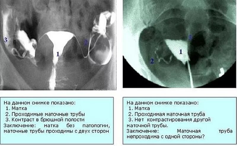 Удаление стенки матки