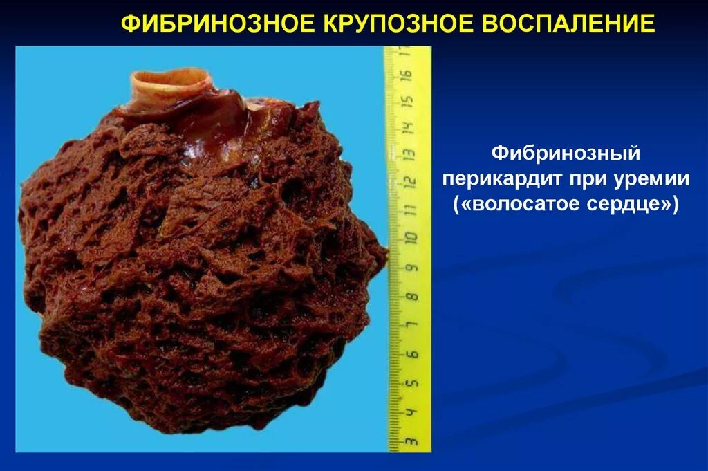 Фибринозный перикардит волосатое сердце. Фибринозный перикардит ("волосатое сердце") макропрепарат. Фибринозное воспаление патанатомия. Фибринозный периостит.