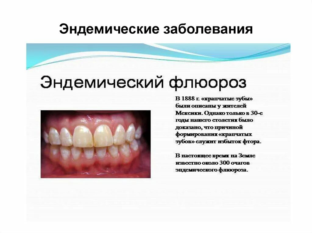 Флюороз зубов (эндемический флюороз зубов) —. Эндемические заболевания флюороз. Меловидно крапчатый флюороз. Меловидно крапчатая форма флюороза.