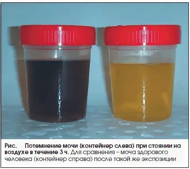Почему моча черного цвета. Изменение цвета мочи причины. Темная моча причины. Темный цвет мочи. Черная моча при.