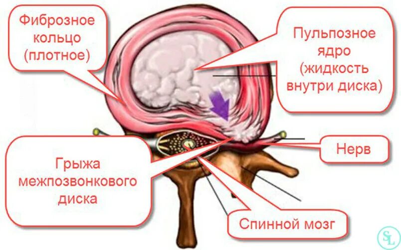 Грыжа фиброзное кольцо. Пульпозное ядро и фиброзное кольцо. Разрыв фиброзного кольца. Разрыв фиброзного кольца диска.