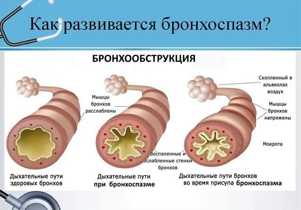 Бронхиолоспазм. Парадоксальный бронхоспазм.