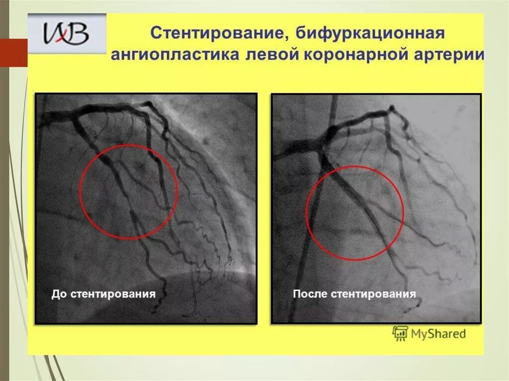 Инфаркт коронарное стентирование. Стентирование коронарных артерий схема. Коронарография стентирование сосудов сердца. Баллонная ангиопластика коронарных артерий. Стенозирование коронарной артерии.