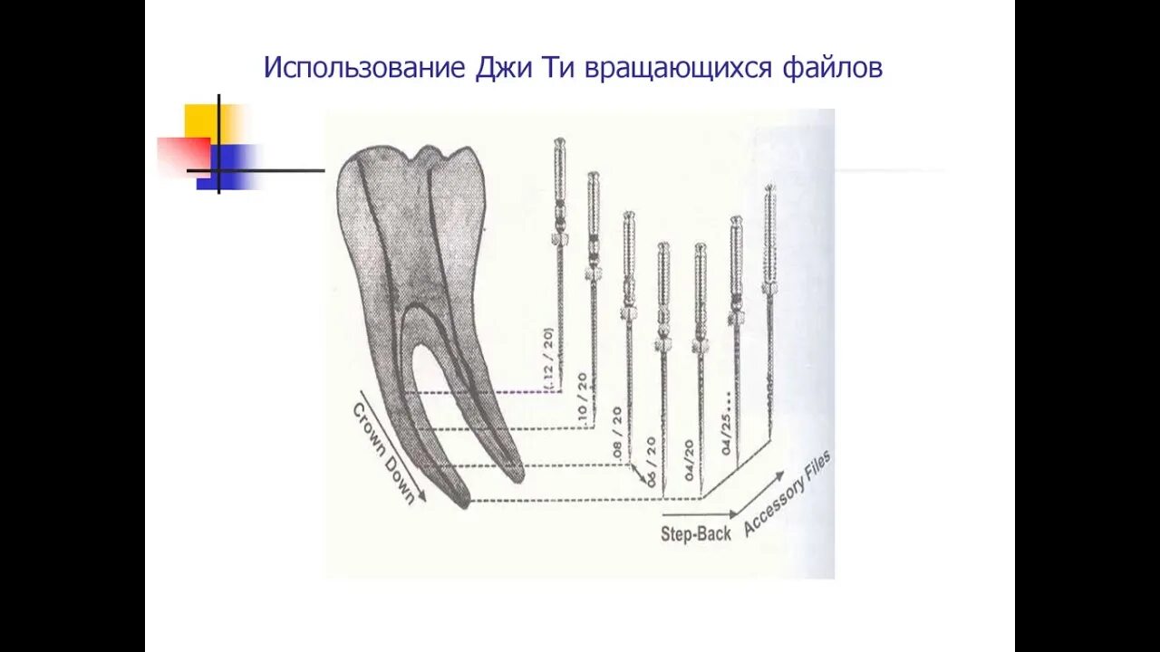 Расширения корневого канала “Step back”. Инструменты.. Техника Step back в эндодонтии. Степ бэк обработка корневых каналов. Методика Step back в стоматологии. Этапы эндодонтического лечения