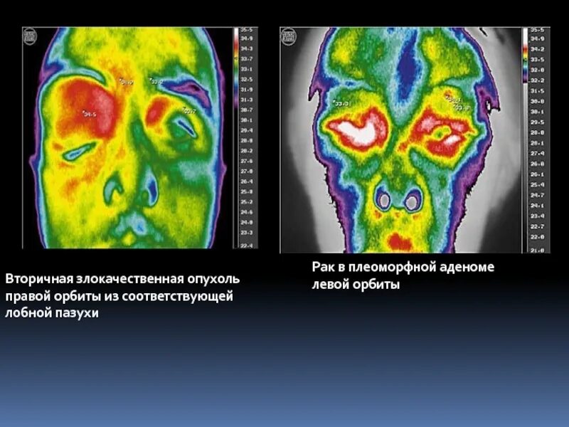 Злокачественные новообразования орбиты. Новообразование левой орбиты. Раковые опухоли орбиты. Опухоли орбиты